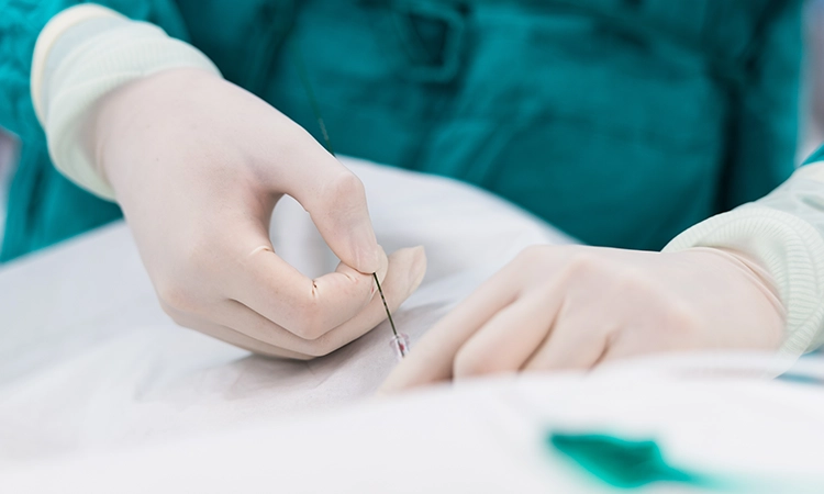 コラム：What Is a Guidewire?  Roles, Types, and Uses Explained
