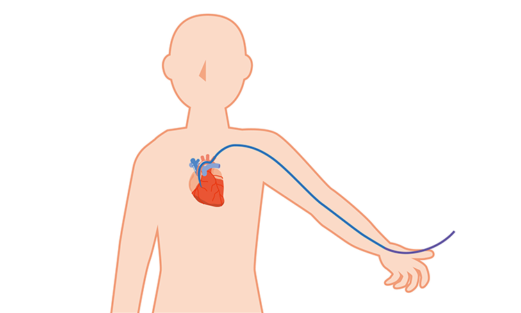 コラム:Vascular Catheters: Clinical Applications and Device Types