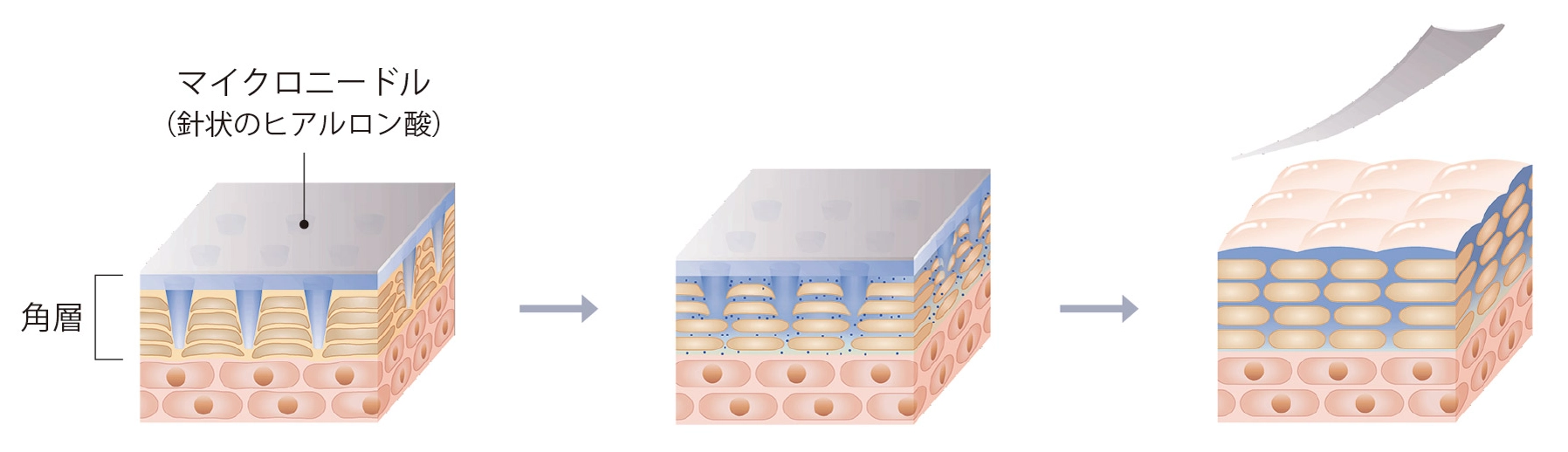 マイクロニードルパッチで高分子の美容成分を効率的に浸透させる
